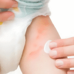 parte interna da coxa do bebê com dermatite de fralda