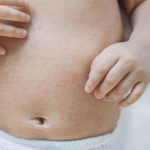 imagem mostrando a importância de prevenir alergias e assaduras em bebês
