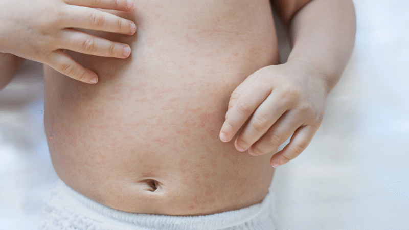 Cuidados com a Pele do Bebê: Como Prevenir Alergias e Assaduras